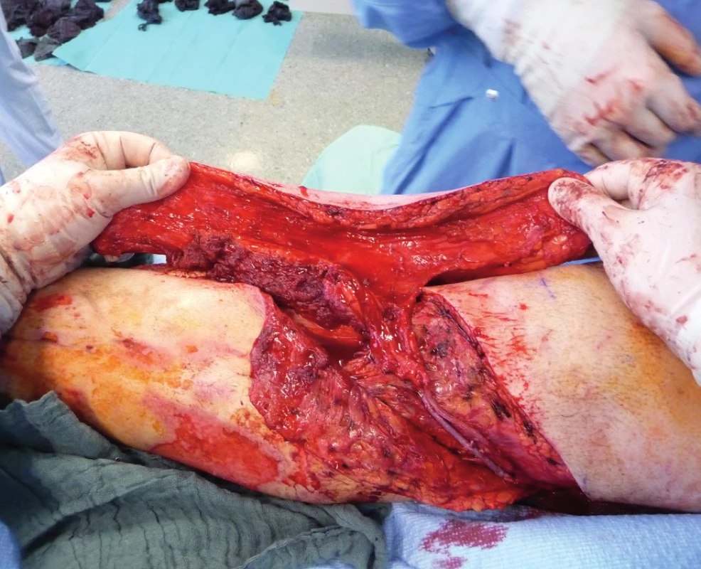 Due to previous intravascular procedure, the Corllet
loope harvested v. saphena magna was performed as an
arterial-venous shunt via a. poplitea above Astron stent,
v. poplitea end to side, prolonging source blood flow to final
ALT pedicle end to end venous-venous and arterial-arterial
anastomosis