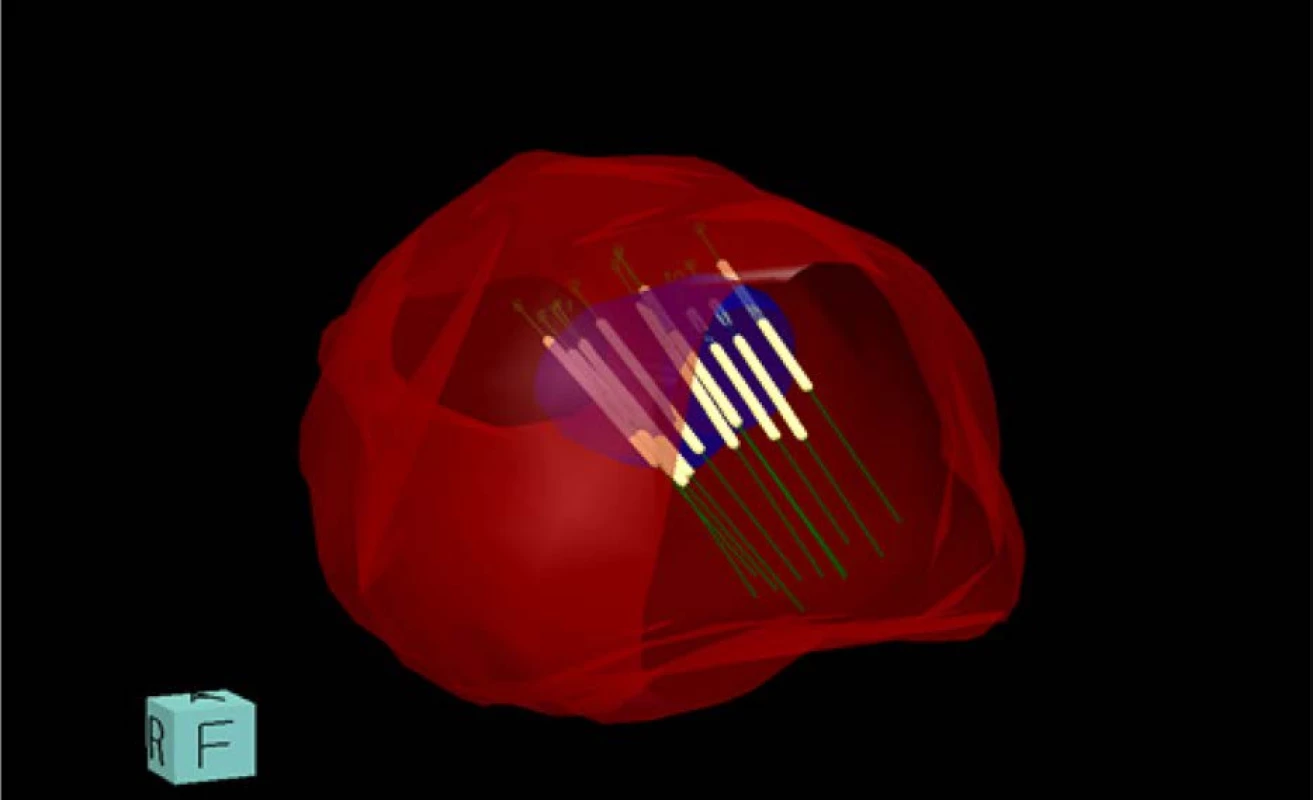 3D model prostaty s bioptickými vzorky<br>
Fig. 2. 3D model of prostate with bioptic patterns