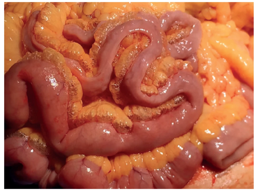 Peroperační nález – pneumomezenterium <br>
Fig. 3: Peroperative finding – pneumomesenterium