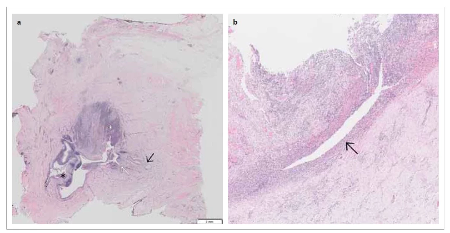 Histologické vyšetření resekátu (H. E.).<br>
a) Zřasená stěna cysty, krytá vrstevnatým dlaždicobuněčným epitelem je prostoupena výrazným lymfoplazmocytárním infiltrátem, který se nachází v okolní silně fibrotizované tkáni (bílá hvězdička) i uvnitř cysty (černá hvězdička). Patrné je vnitřní ústí píštěle, tvořené nespecifickou granulační tkání (bílá šipka). V její blízkosti zachycen vlasový folikul s mazovou žlázou (černá šipka).<br>
b) Podkožní část píštěle, tvořené nespecifickou granulační tkání se silným chronickým zánětlivým infiltrátem (černá šipka).<br>
Fig. 3. Histological examination (H. E.).<br>
a) The creased wall of the cyst, covered by stratified squamous cell epithelium, permeated by a prominent lymphoplasmacytic
infiltrate detected in the surrounding heavily fibrotized tissue (white asterisk) and inside the cyst (black asterisk). An
apparent inner orifice of the fistula, formed by non-specific granulation tissue (white arrow). A hair follicle with sebaceous
gland (black arrow) in the neighborhood.<br>
b) The subcutaneous part of the fistula, consisting of non-specific granulation tissue with a strong chronic inflammatory infiltration
(black arrow).