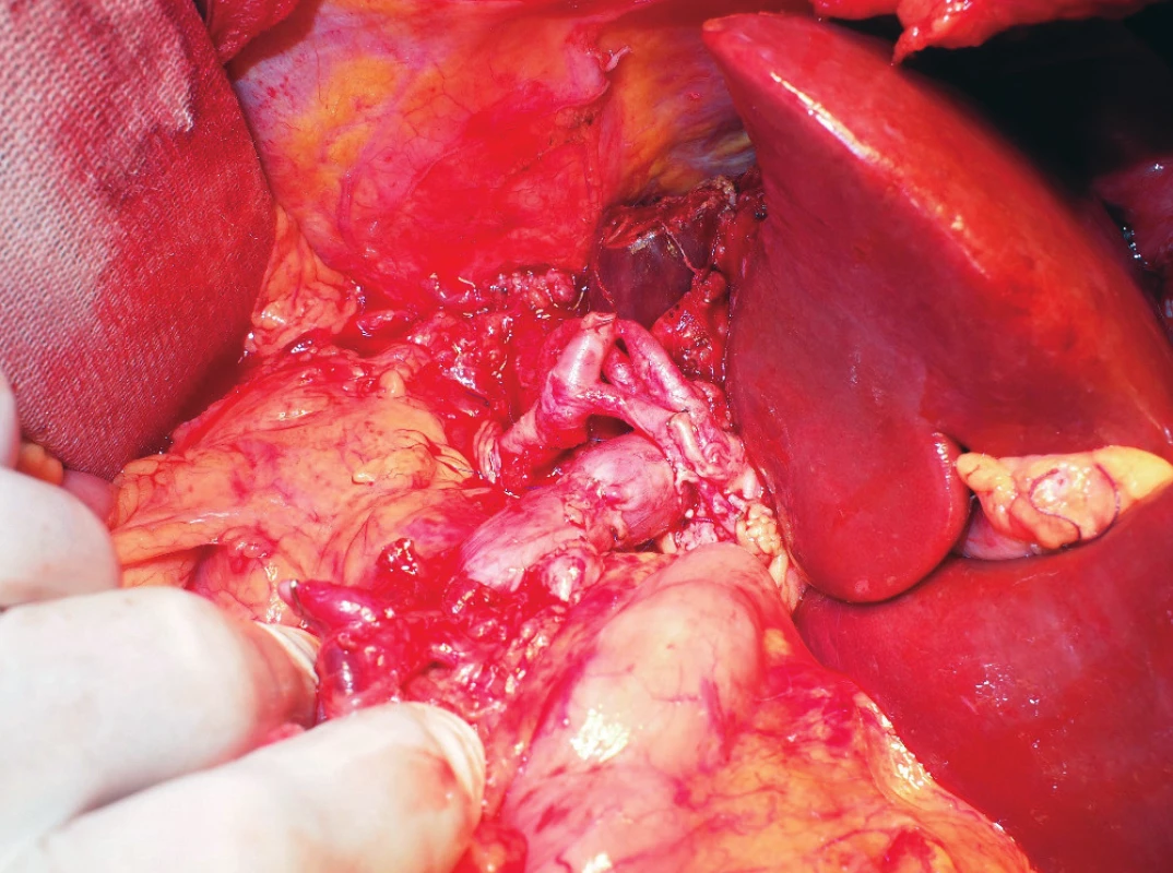 A detailed view of the established portal vein
anastomosis and aortohepatic bypass<br>
The picture was taken after reperfusion of the graft. The biliary
duct anastomosis is not clearly visible in this image.