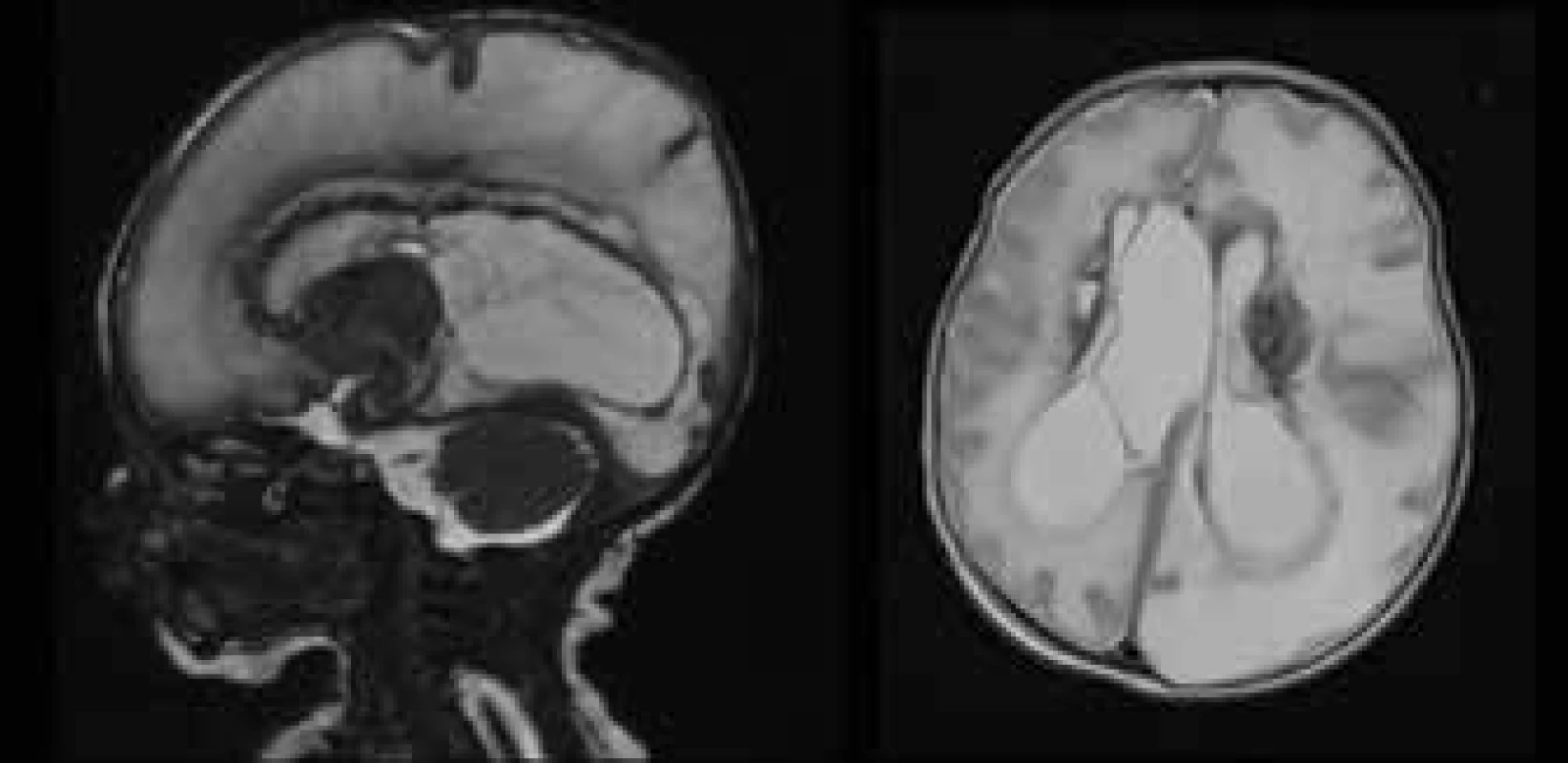 MRI examination of CNS – extensive ischemic-pseudocystic
changes of both brain hemispheres, husky parenchyma on left and
bilaterally evident periventricular haemorrhage.