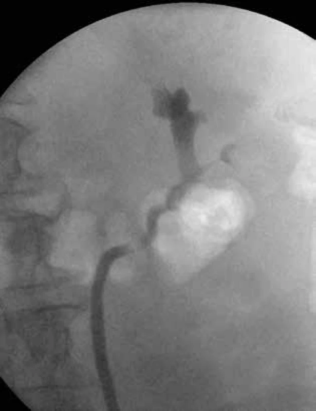  Uroteliální karcinom pánvičky – ascendentní pyelografie (defekt kontrastní náplně dolního kalichu) <br>
Fig. 3: Urothelial carcinoma in the renal pelvis – ascendent pyelography (a contrast medium filling defect in the
lower calyx) 