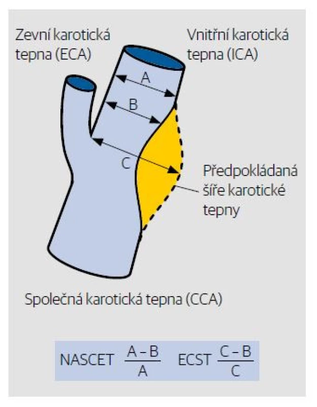 Kvantifikace stupně stenózy podle kritérií
NASCET a ESCT (výpočet stenózy z „B mode“
zobrazení). V současnosti používáme výpočet
stenózy podle NASCET.