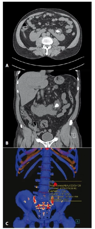 a, b, c. 3D projekcia umiestnenia pelvilitiázy
ľavého segmentu ren arcuatus<br>
Fig. 2a, b, c. 3D projection of placement of pelvilithiasis
in the left portion of horseshoe kidney