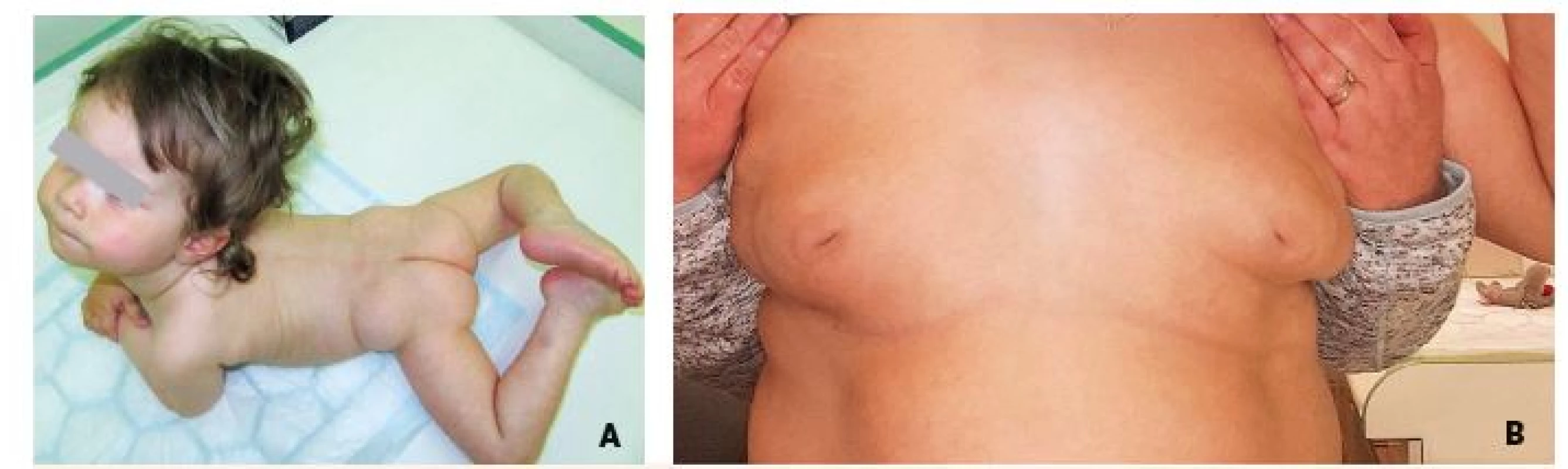 A. Strabismus, neprospívání a atypická distribuce tuku v oblasti zadečku u 12měsíční dívky s dědičnou poruchou glykosylace
typu PMM2-CDG. B. Přetrvávající invertace mamil u 17leté dívky s PMM2-CDG.<br>
Fig. 11. A. Strabism, failure to thrive and atypical supragluteal fat distribution in 12-month-old girl with congenital disorder of glycosylation
(CDG) type phosphomannomutase deficiency (PMM2). B. Persisting nipple inversions in 17-year-old girl with PMM2-CDG.