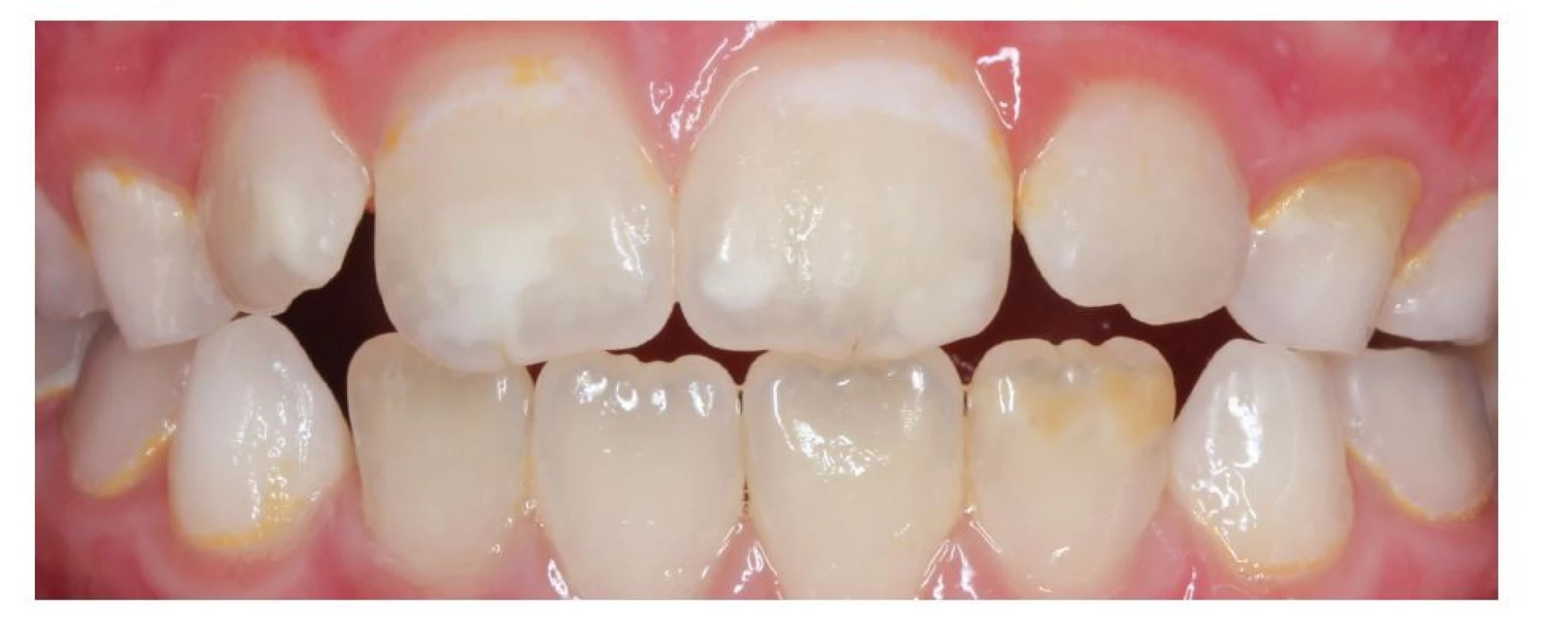 Bílé opacity na zubech 12,
11, 21 a hnědá opacita na
zubu 32<br>
Fig. 1
White opacities on the teeth 12,
11, 21, and a brown opacity on
the tooth 32
