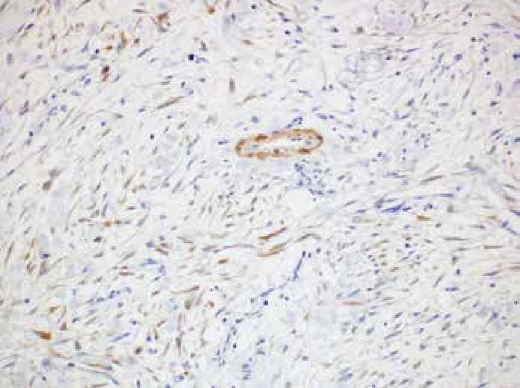 Lesional cells expressing occasional isolated positivity for alpha actin
(original magnification 200x).