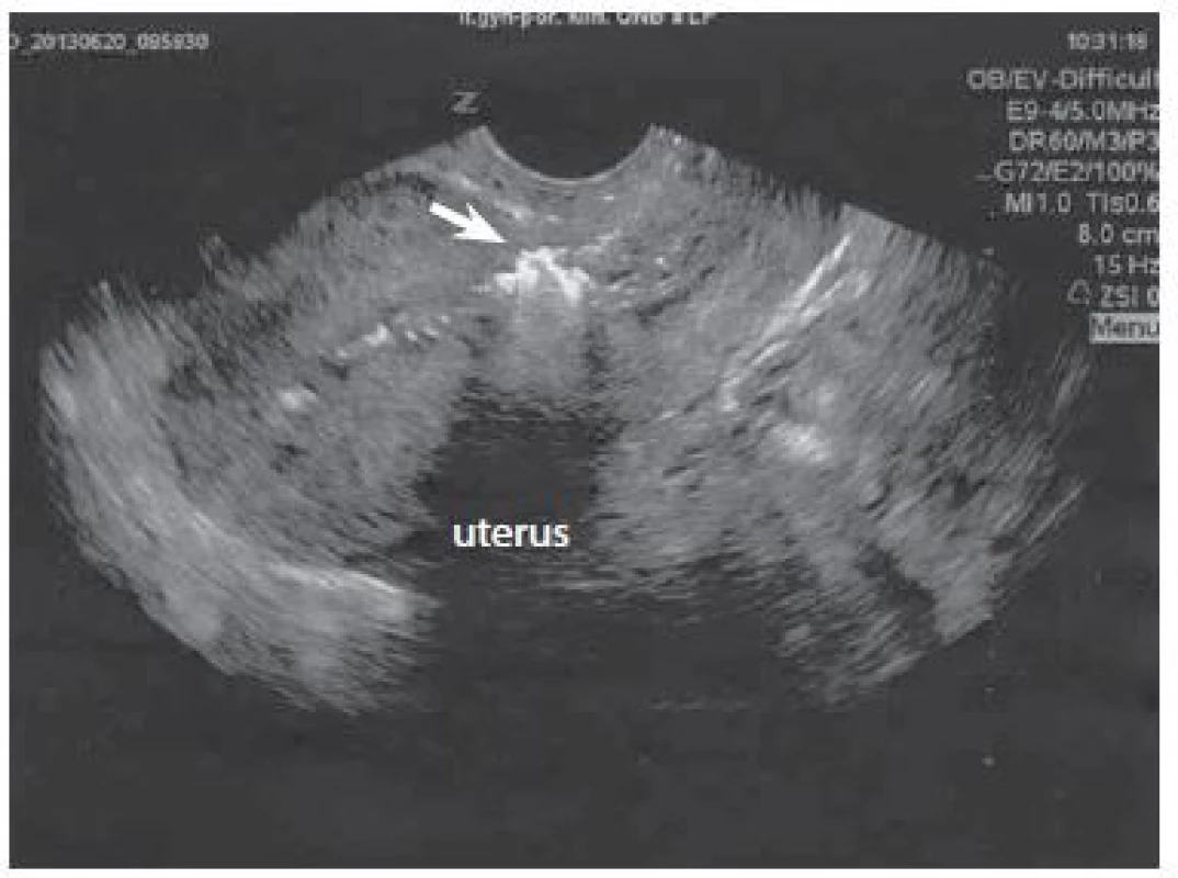 Prázdna dutina uteru v mieste jazvy po cisárskom reze (šípka) po sonografi cky riadenej vákuumaspirácii, foto autori. </br> Empty uterine cavity at the scar site following
a caesarean section (arrow) after sonographically controlled vacuum aspiration, photo by the authors.