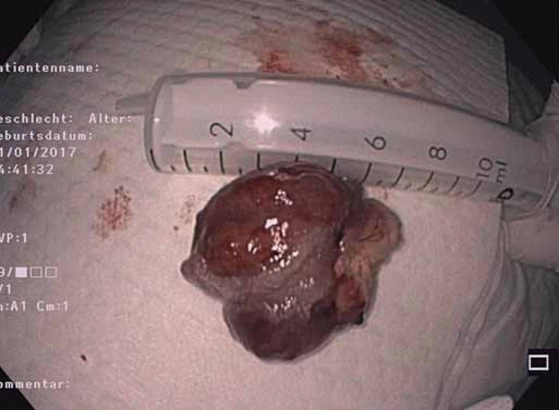 Resekát polypu duodéna.<br> Fig. 8. Resected duodenal polyp.