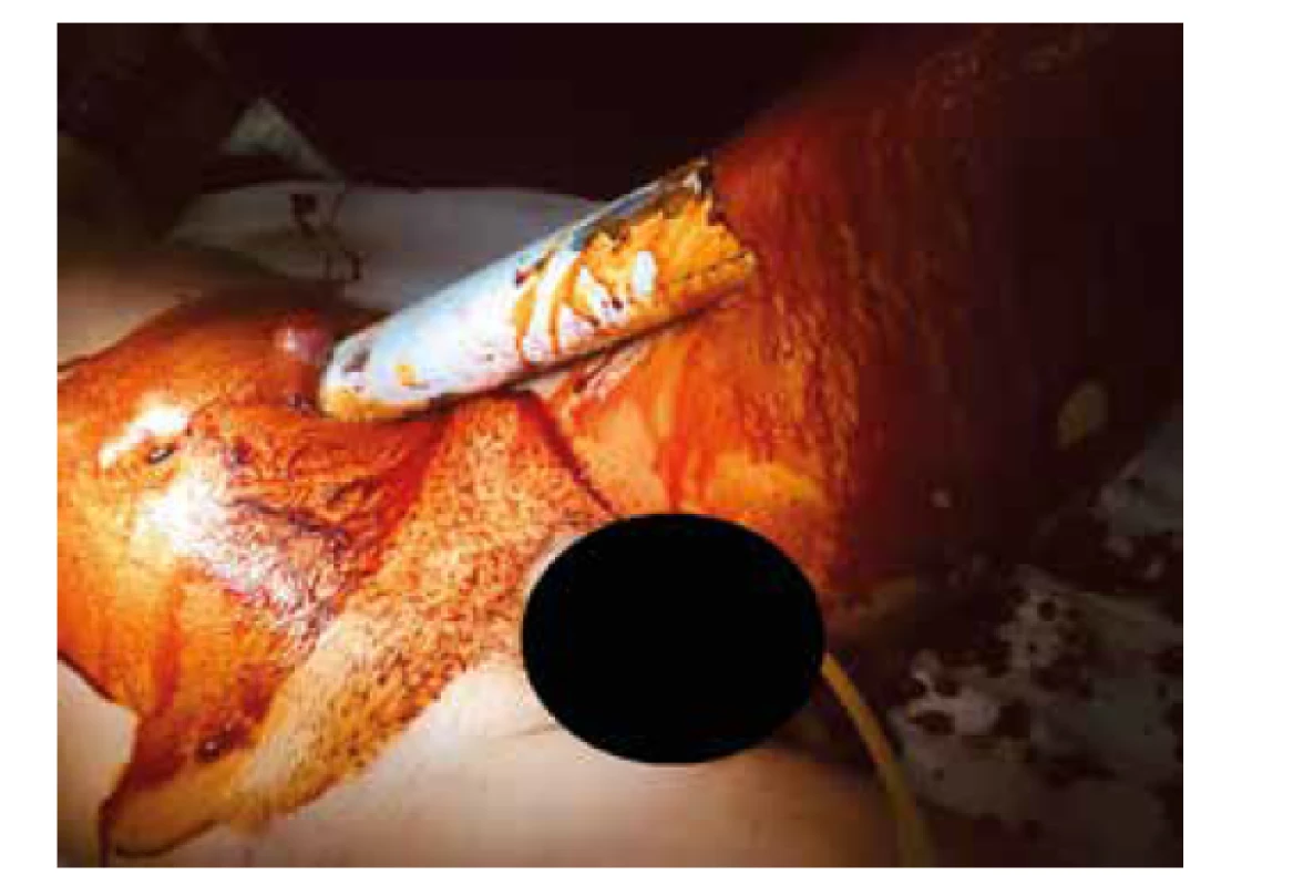 Vstup trubky – levé mezogastrium, jejunum<br>
Fig. 9: Entry of the tube – left mesogastrium, jejunum