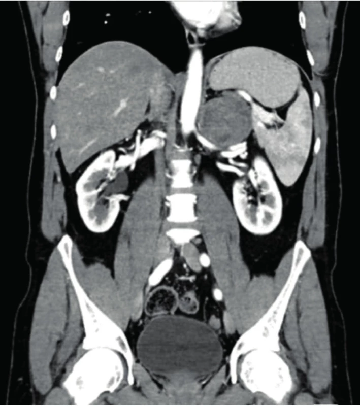 Tumor levé nadledviny<br>
Fig. 2. Left adrenal tumor