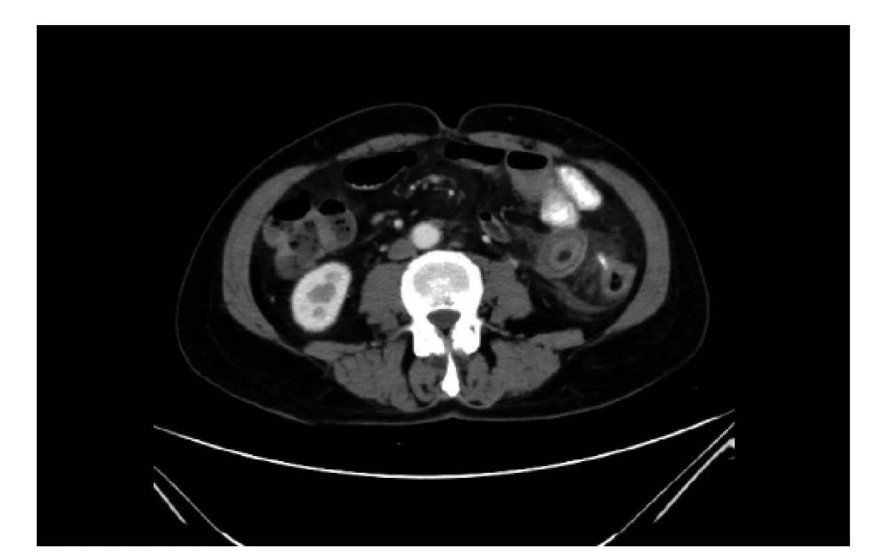 Axiální CT řez s nálezem cizího tělesa s průkazem
perforace tračníku<br>
Fig. 2: Axial CT section with evidence of a foreign body
and descending colon perforation