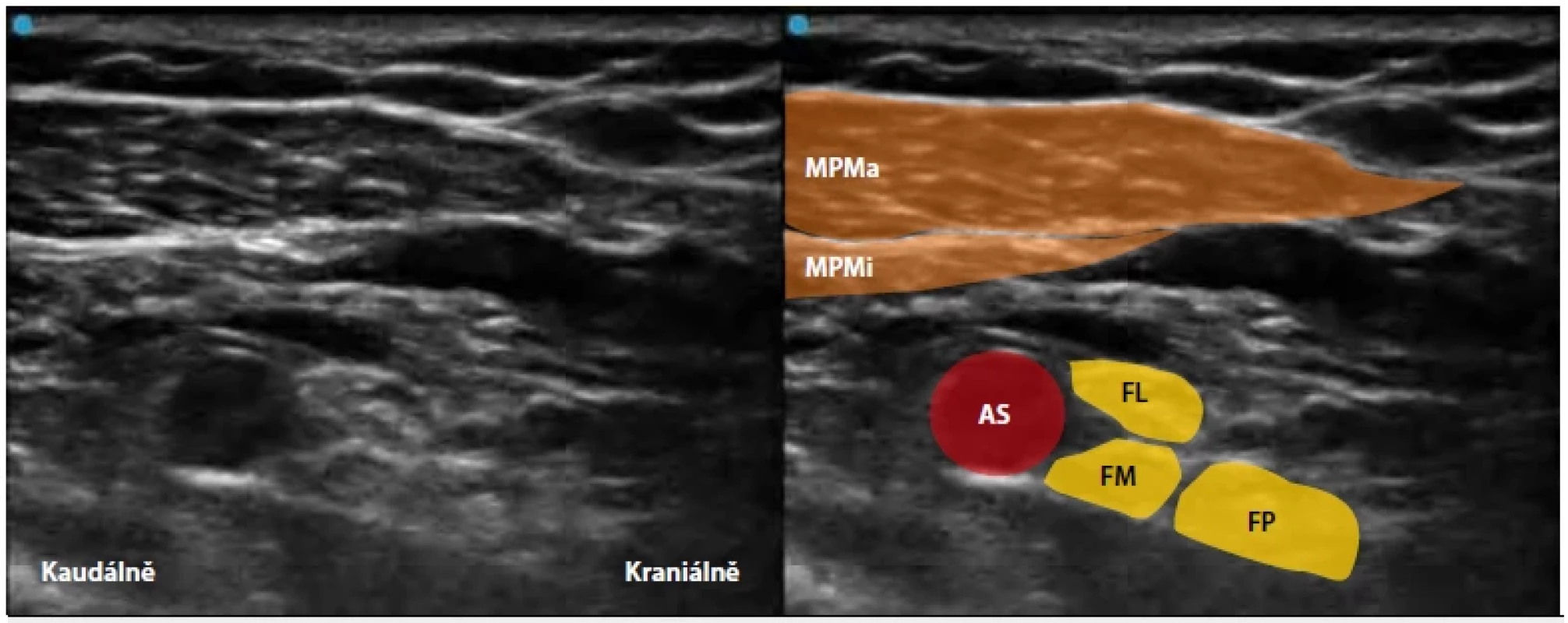 Infraklavikulární blokáda plexus brachialis
Kaudálně