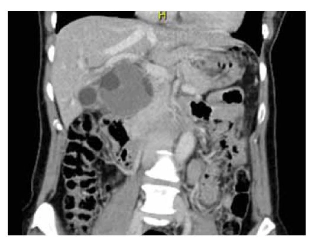 CT břicha: solidně-cystické ložisko subhepatálně
s útlakem žlučovodu.<br>
Fig. 2. CT of the abdomen: solid-cystic lesion subhepatic with
bile duct oppression.
