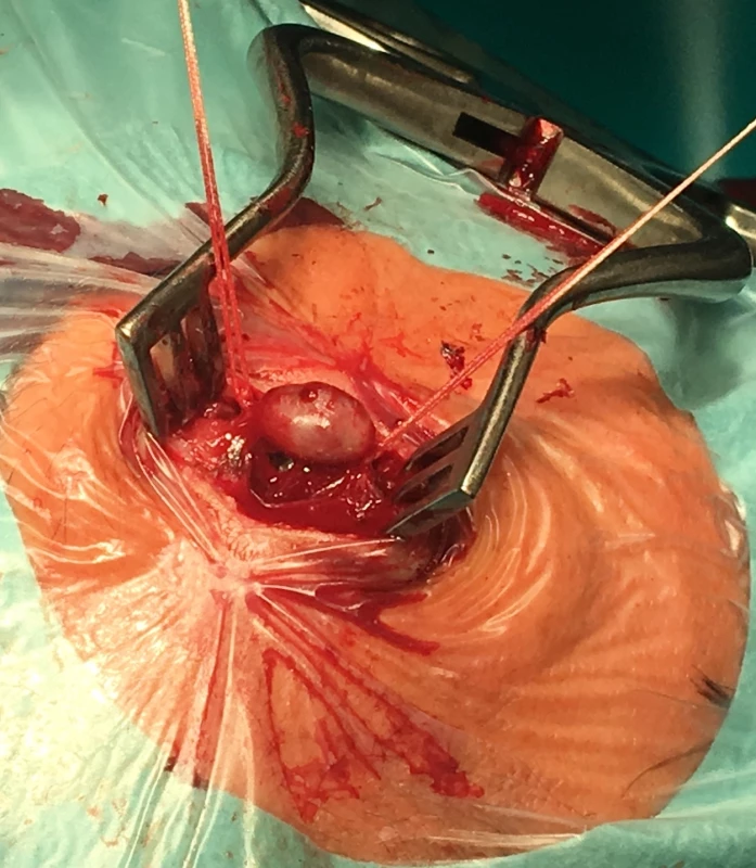 Peroperační fotografie, stav po vypreparovaní vaku a ligaci přívodné a odvodné tepny.<br>
Fig. 3. Operative image, there is a pseudoaneurysm before excision.