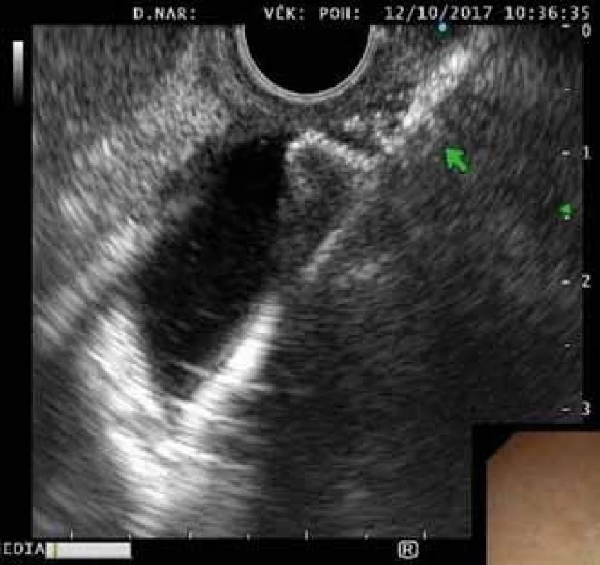 EUS obraz rozvinutého distálního konce stentu ve žlučovodu.<br>
Fig. 2. EUS imaging of the distal flange in the bile duct.