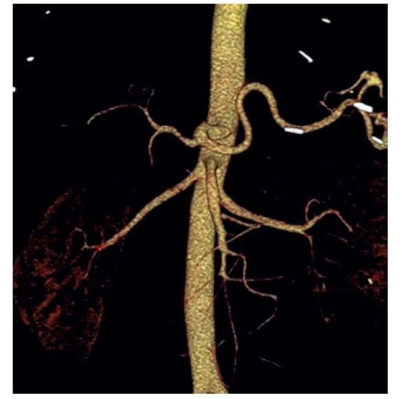 Výduť slezinné tepny (CT-AG)<br>
Fig. 4: Splenic artery aneurysm (CT-AG)