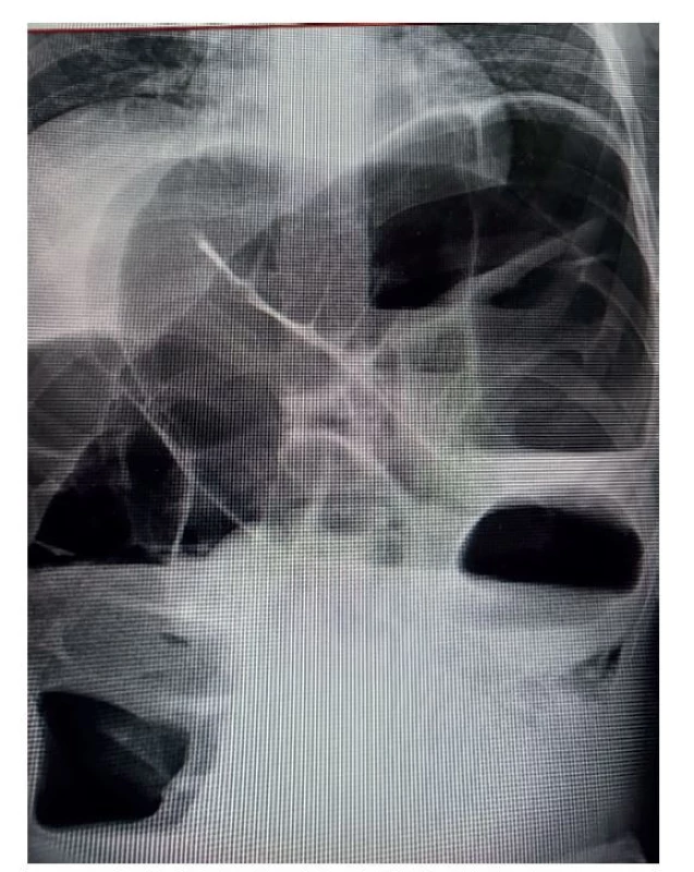 Rtg břicha<br>
Fig. 1: X-ray of the abdomen