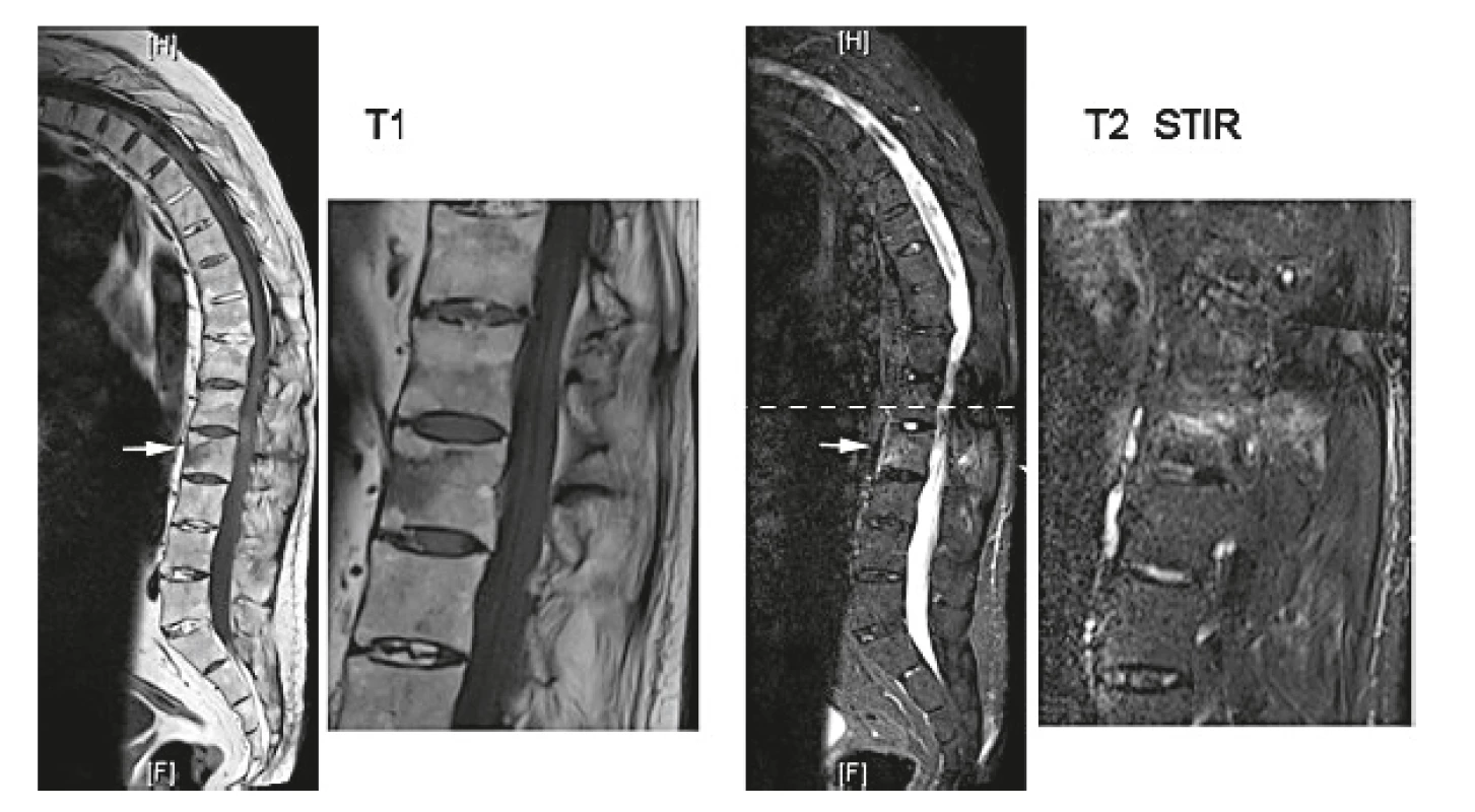 Vertebrální fraktura u pacienta s ankylozující spondylitidou