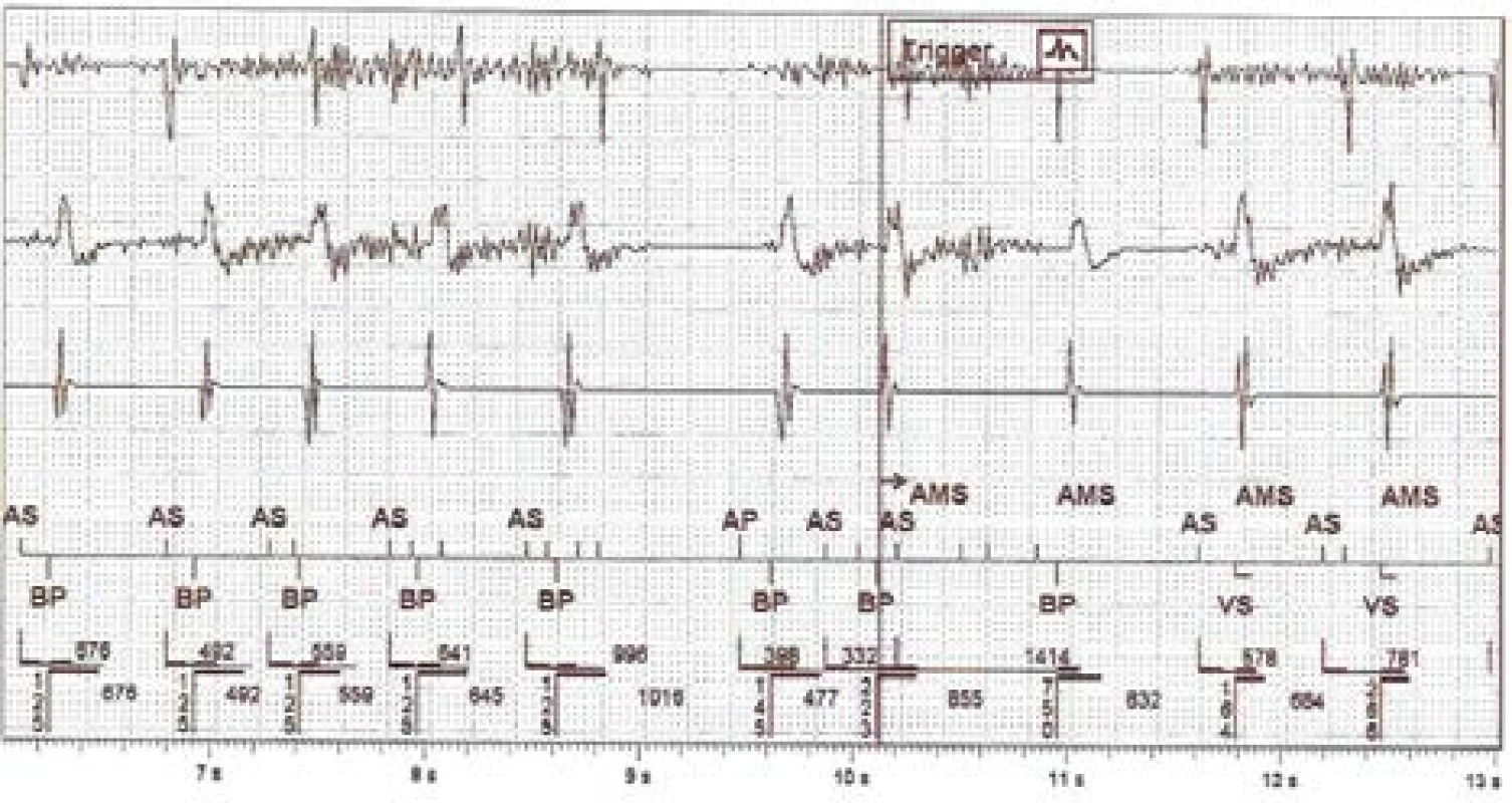 The intracardiac recording of improper detection on near-field channel (1st line is atrial, 3rd ventricular) and far-field RV Coil–Can channel (2nd line).
N.B.: Marker AS = Atrial Sense, BP = Biventricular
Pace, VS = Ventricular Sense, AMS = Automatic Mode
Switching