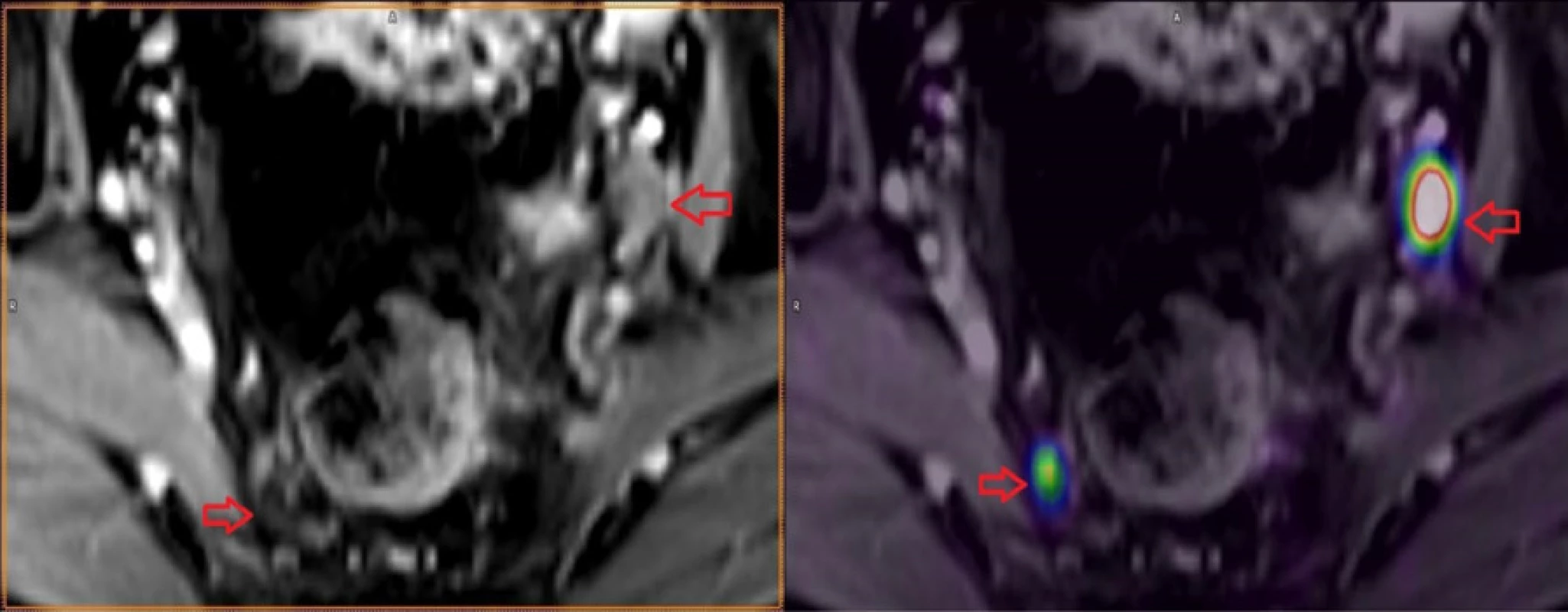 Metastázy do lymfatických uzlin karcinomu prostaty<br>
Fig. 4. Lymph nodes metastases in prostate cancer 