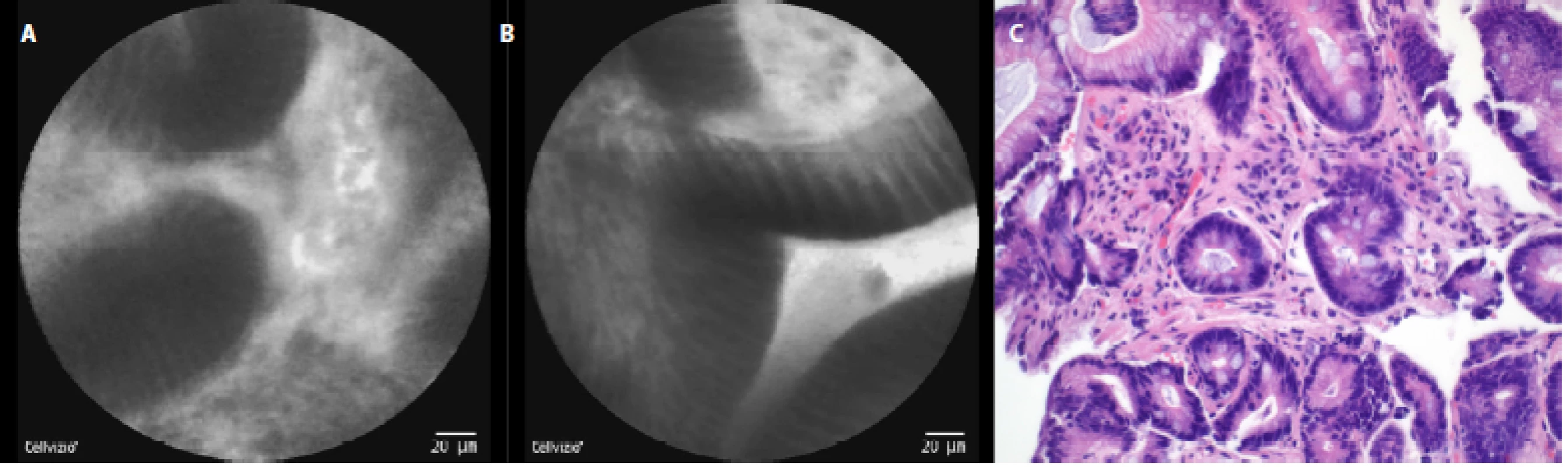 pCLE view of BE with low grade dysplasia: a - non-round shaped glands with dark columnar cells, b - variable degree of darkness with sharp cutoff of the columnar epithelium; c – histopathology examination: glands with columnar epithelium with lack of goblet cells and nuclear enlargement, haematoxylin-eosin staining 40×