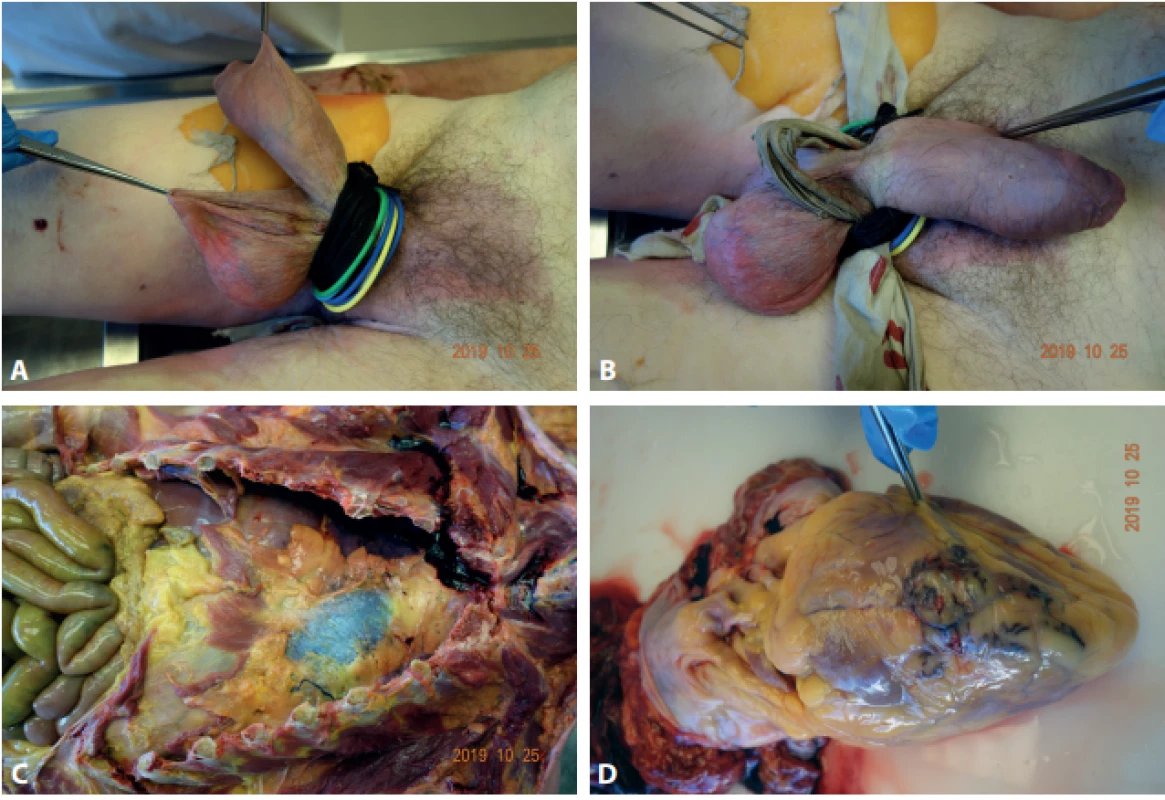 The autopsy fi ndings of 69-year-old man. A: Tightly bandaged genitalia. B: Genitalia bandaged by rubber bands and shoe laces. C: Visible
blood in the pericardial cavity (asterisk). D: The small tear of left ventricular free wall (arrow).