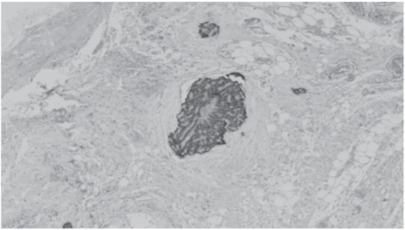 Metastatic foci of cancer with positive staining with
antibody against parathormone in lipomatous tissue.