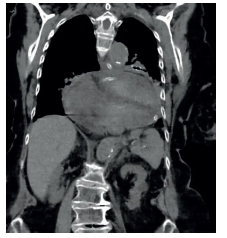 Volvulus žaludku v CT obraze se zavedenou
nazo-gastrickou sondou<br>
Fig. 2. Stomach volvulus on a CT scan with inserted
naso-gastric tube
