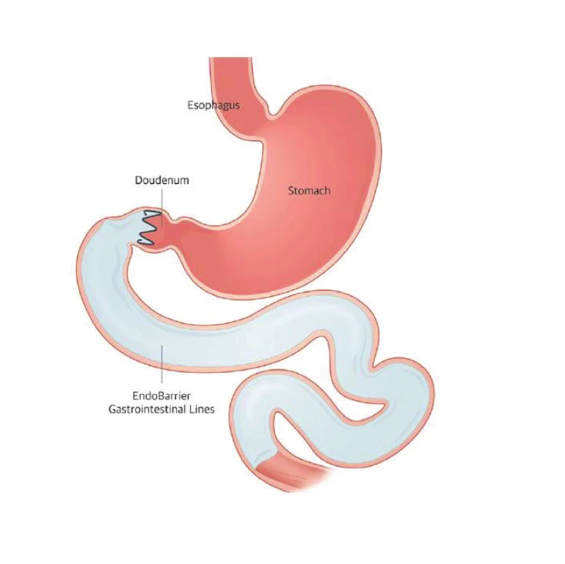 Duodenojejunální rukáv<br>
Fig. 1: Duodenojejunal sleeve