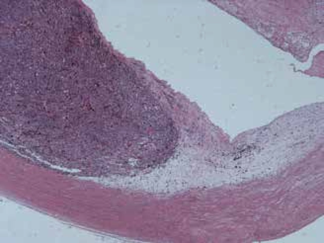 Recurring melanoma of the corpus ciliare, spindle cell type B, enlarged 25x
