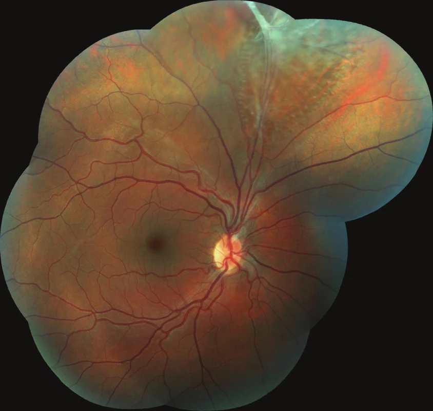 Colour photographic image of the fundus of the right eye: the retina is thinned in the upper quadrants, in the upper temporal arcade there are residues of persistent hyaloid artery with fibrotic tissue, causing local retinoschisis of an older date.