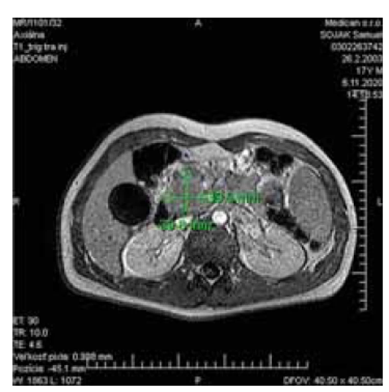 Magnetická retrográdna cholangiopankreatikografia, 
ktorá zobrazuje rozšírenú hlavu pankreasu.<br>
Fig. 1. Magnetic retrograde cholangiopancreatography
showing the dilated
head of the pancreas.