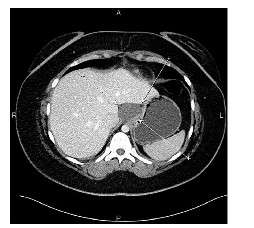 CT obraz bronchogenní cysty kardie – šipky ukazují
stěny cysty<br>
Fig. 1: CT image of the bronchogenic cyst of the cardia –
cyst walls indicated by arrows