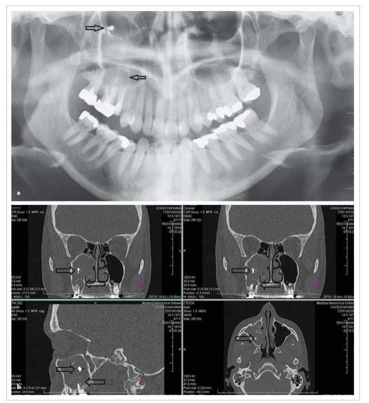 Periapikální granulom zubu 16 a fungus ball v pravé č elistní dutině na OPG (a) a CT (b).<br>
Fig. 2. Periapical lesion of tooth 16 and fungus ball in the right maxillary sinus OPG (a) and CT (b).