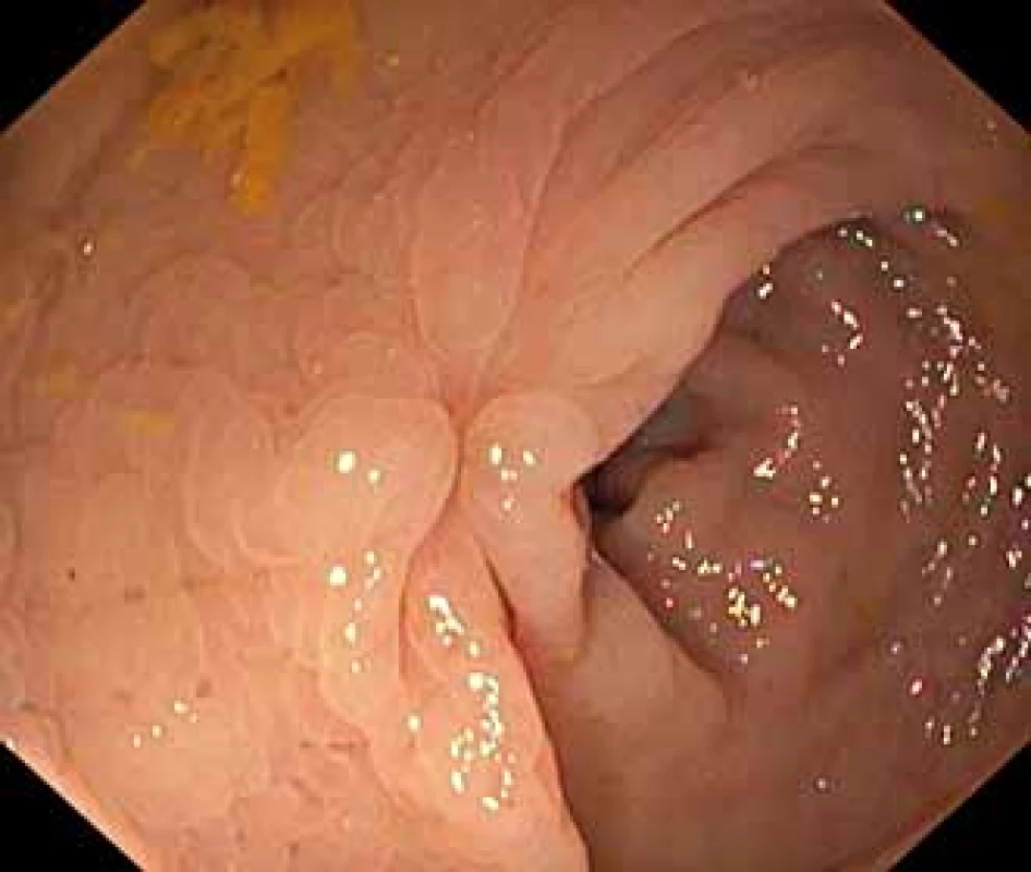 Jizva po endoskopické léčbě
lipomu rekta.
Fig. 2. Scar after endoscopic treatment
of rectal lipoma.