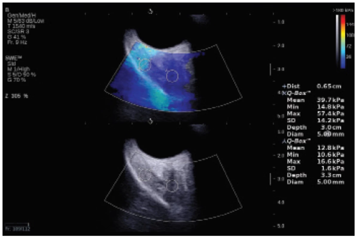 Measurement of elasticity of fibrotic musculus
rectus superior