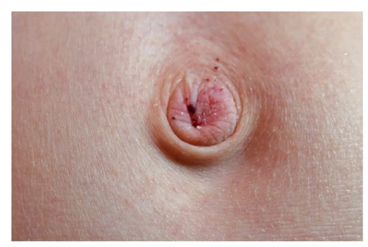 Angiokeratomy umbiliku chlapce z kazuistiky (12 let)