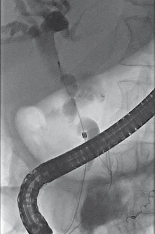 ERCP – aplikace kontrastní
látky do žlučových cest s plněním dutiny
pseudocysty.
Fig. 4. ERCP – application of contrast
medium into the biliary tract with filling
of the pseudocyst cavity.