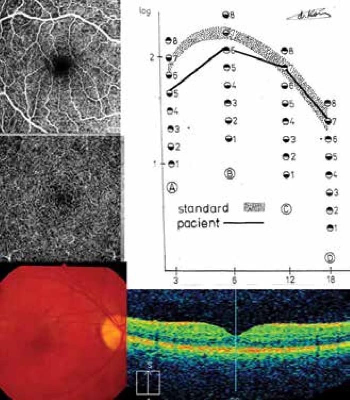 DpR1: CS, SD-OCT, OCT-A a fundus u pacienta 1 (Tabulka
1)