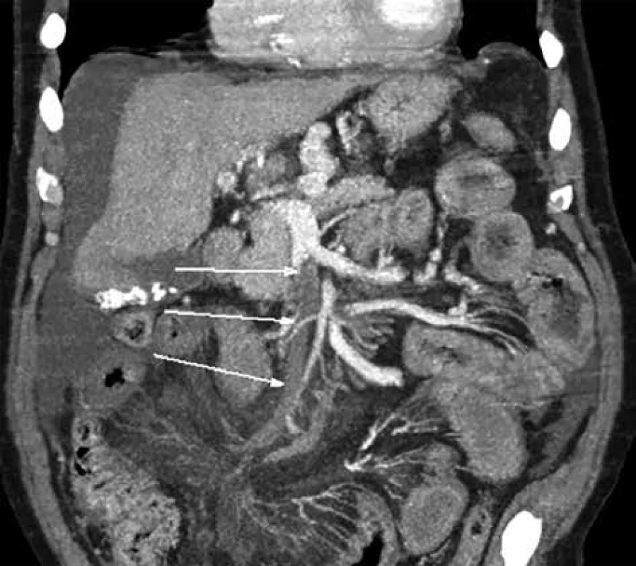 Trombóza horní mezenterické žíly<br>
Fig. 4: Thrombosis of the upper mesenteric vein