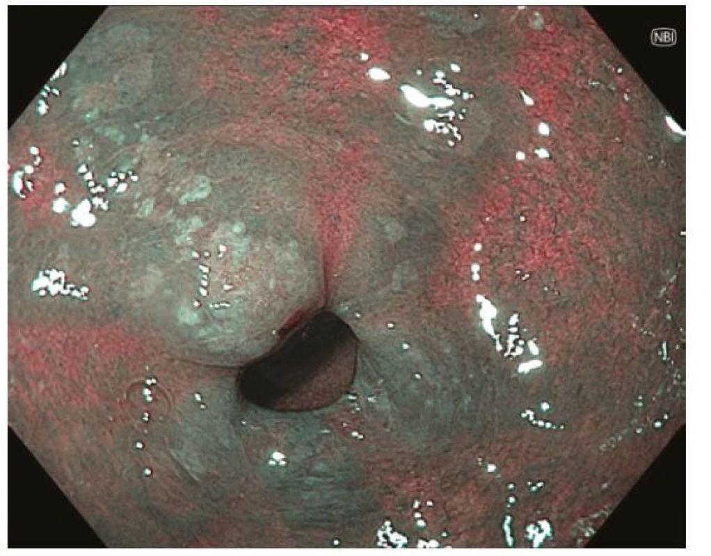 Intestinální metaplazie mapovitými okrsky bělavé, mírně vyvýšené
sliznice