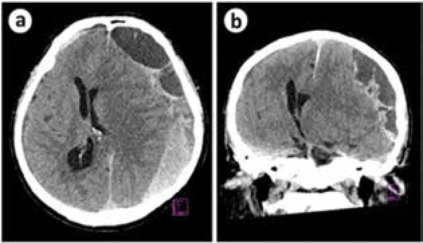 Chronický subdurální hematom s významnou
porcí čerstvého krvácení a výrazným expanzivním
chováním hematomu<br>
Fig. 4. Chronic subdural hematoma with an acute
hemorrhage causing a significant mass effect