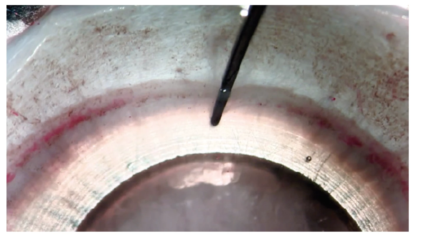 Opening created beneath DM before separation
with the aid of a liquid bubble