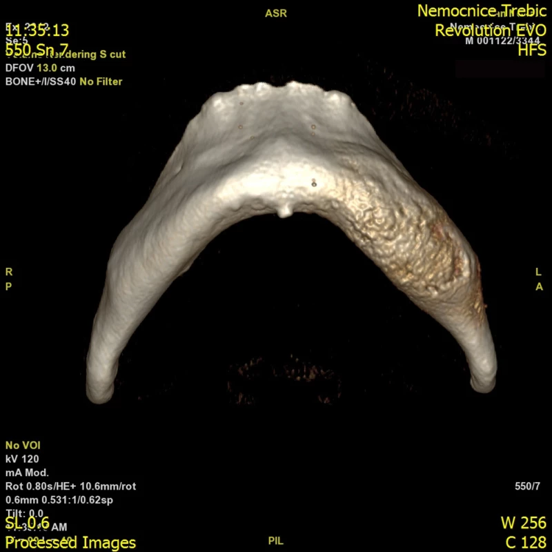 CT zobrazení čelisti pro srovnání, jak je proces vidět na OPG a jak na CT zobrazení. Levá část především těla mandibuly vykazuje známky expanze a smíšený
osteoskleroticko-lytický proces především v kostní dřeni, patrné je zesílení kortikalis bez periostální reakce. K expanzi těla mandibuly došlo vlevo v premolárním-
molárním regionu se známkami sklerózy, intrakortikální osteolýzy, tvorbou nepravidelných sklerotických lemů. Nápadné je rozšíření kanálu n. alveolaris inferior
včetně větvení pro n. incisivus