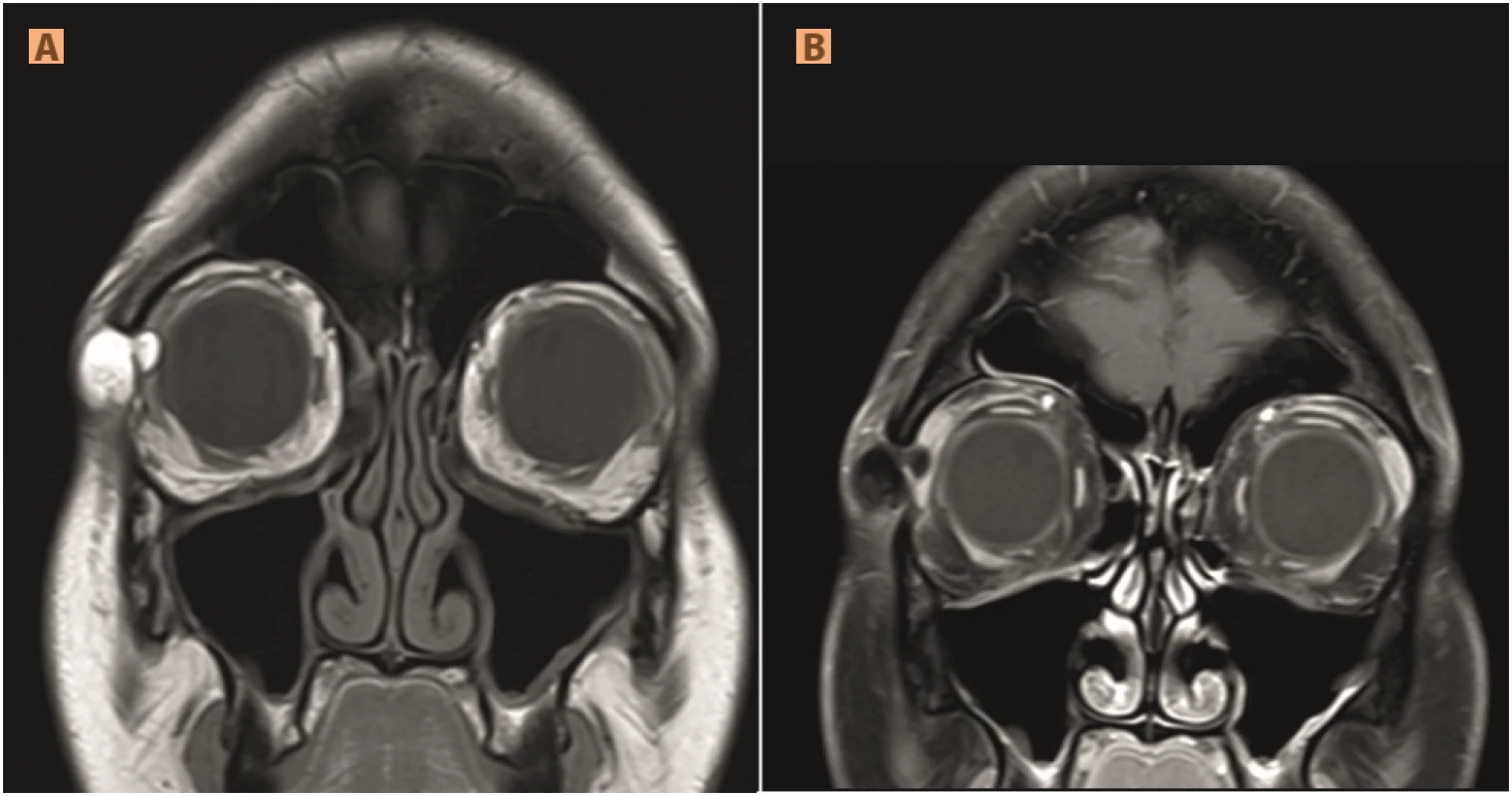 Dermoid cyst: (A) bordered septated formation ensuing from frontozygomatic suture, larger portion subcutaneously, smaller infringing intraorbitally, hypersignal in T1WI, (B) hyposignal T1FS (lipid-rich content)
