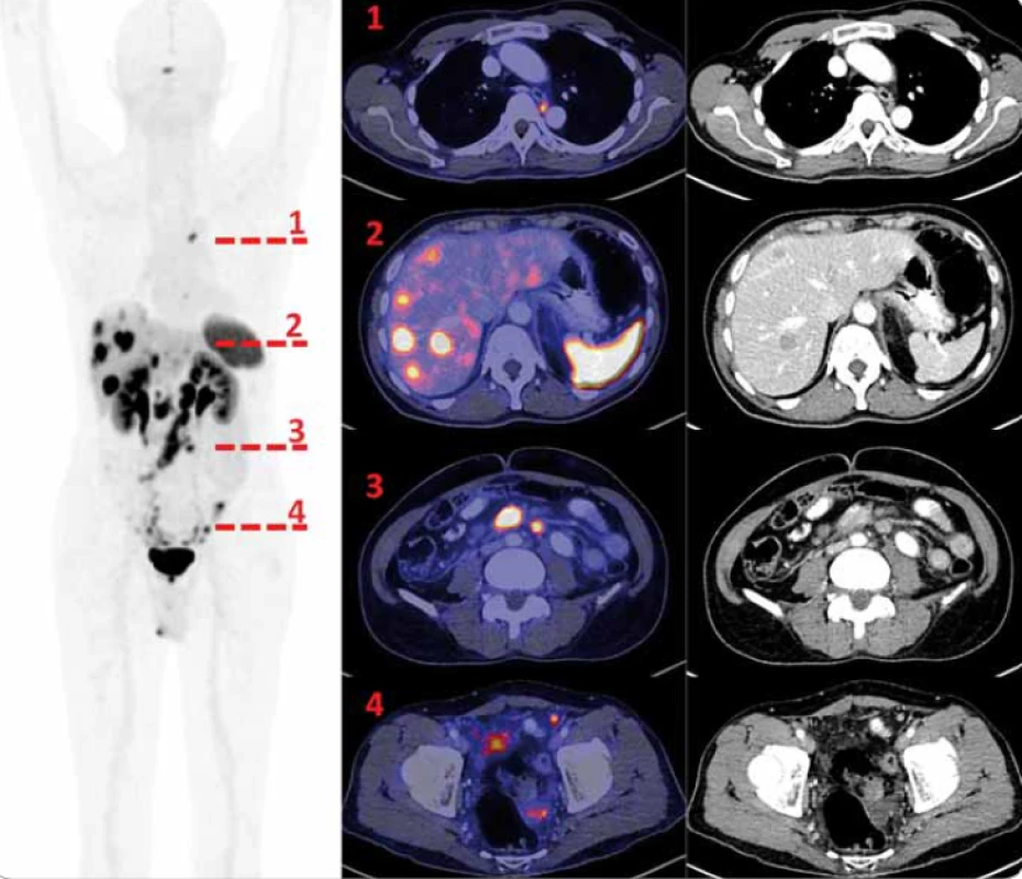 <sup>68</sup>Ga-DOTA-TOC PET/CT vyšetření. Vlevo sumovaná projekce tzv. MIP (maximum
intensity projection) PET vyšetření v černobílé barevné škále, červeně jsou označeny
úrovně axiálních řezů, které jsou v detailech (PET zobrazení v barevné škále Hot Metal)
vpravo. Řada 1 je ve výši dvou drobných splývajících, metabolicky aktivních uzlin mediastina
vlevo mezi aortou a jícnem ve výši obratle Th 5. Řada 2 ukazuje některé z četných
jaterních metastáz (jen některé však mají na CT korelát) a fyziologickou akumulaci radiofarmaka
ve slezině. Řada 3 dokumentuje aktivní, zvětšené uzliny v mezenteriu. V řadě 4
dokumentujeme četná drobná nádorová ložiska v pánvi.