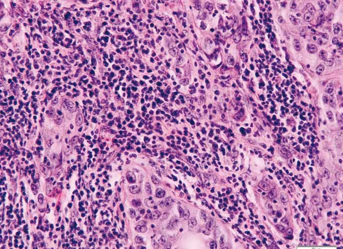 Intratumorální lymfo/plazmocytární infi ltrace uvnitř hranic tumoru při okraji
centrální fibrózy. Barveno hematoxylinem a eozinem.