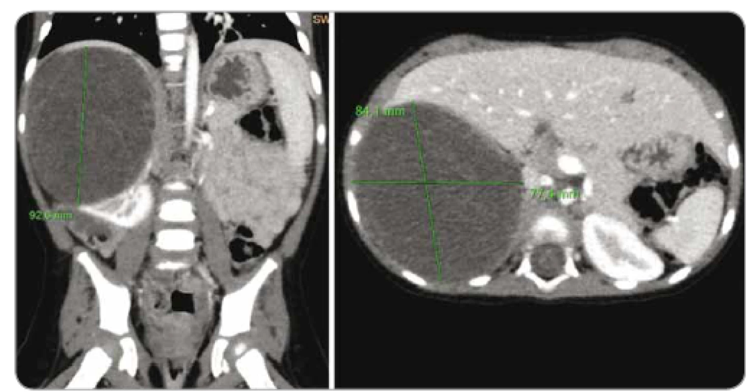 Počítačová tomografie břicha pacientky z kazuistiky 3 – cystický nefrom pravé
ledviny.